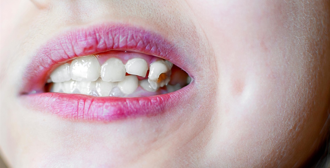 Ein abgebrochener Zahn – Was tun? Soforthilfe und...