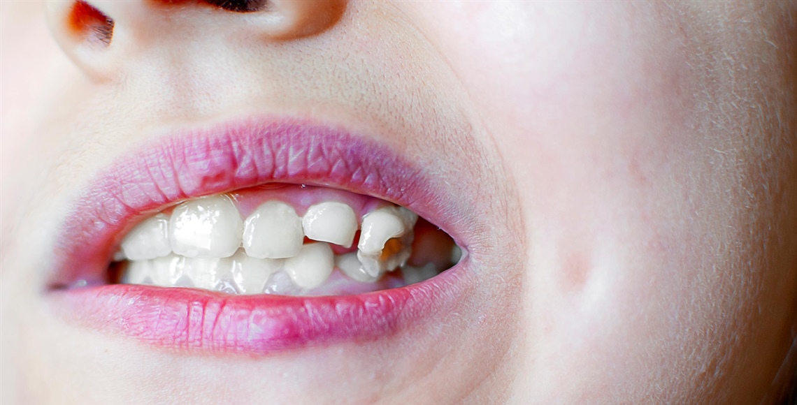 Ein abgebrochener Zahn – Was tun? Soforthilfe und...