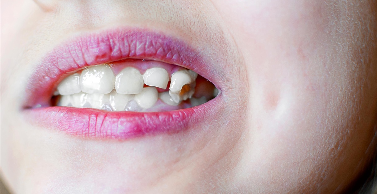 Ein abgebrochener Zahn – Was tun? Soforthilfe und langfristige Lösungen