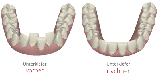 Aligner-Technologie