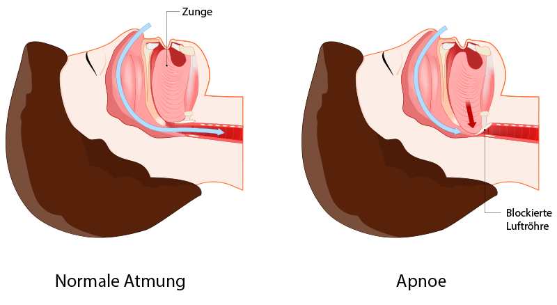 Schnarchen und Apnö